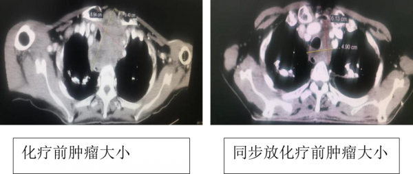 放射治疗，一把“无形的手术刀”