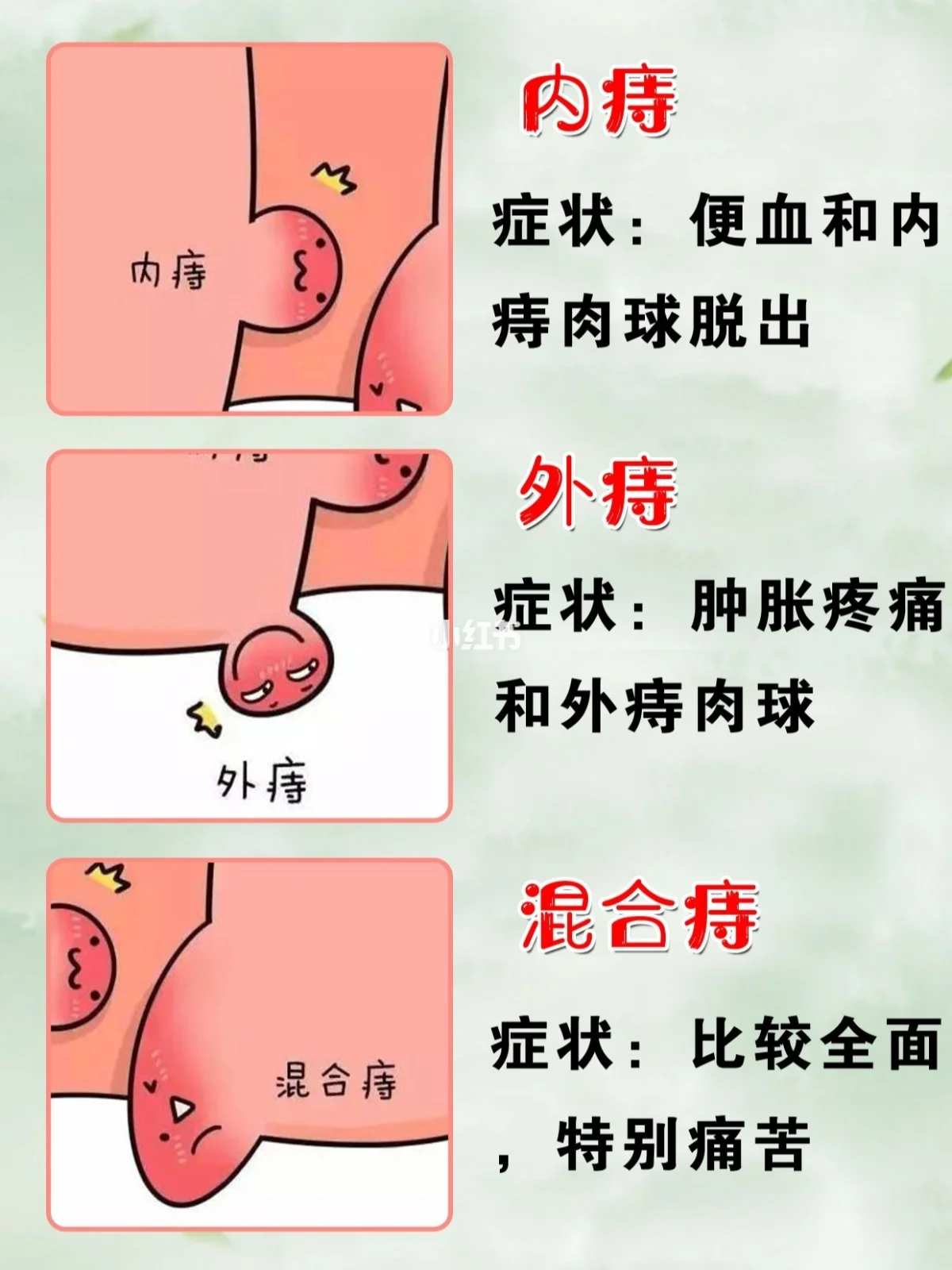 发作预防痔疮的药物_发作预防痔疮吃什么药_怎么预防痔疮发作